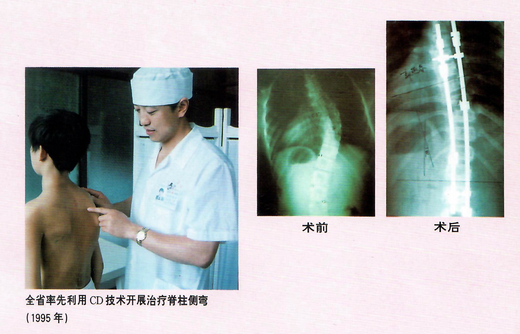 1995年，林海濱教授做了福建省第一例CD技術矯正脊椎側彎手術.jpg